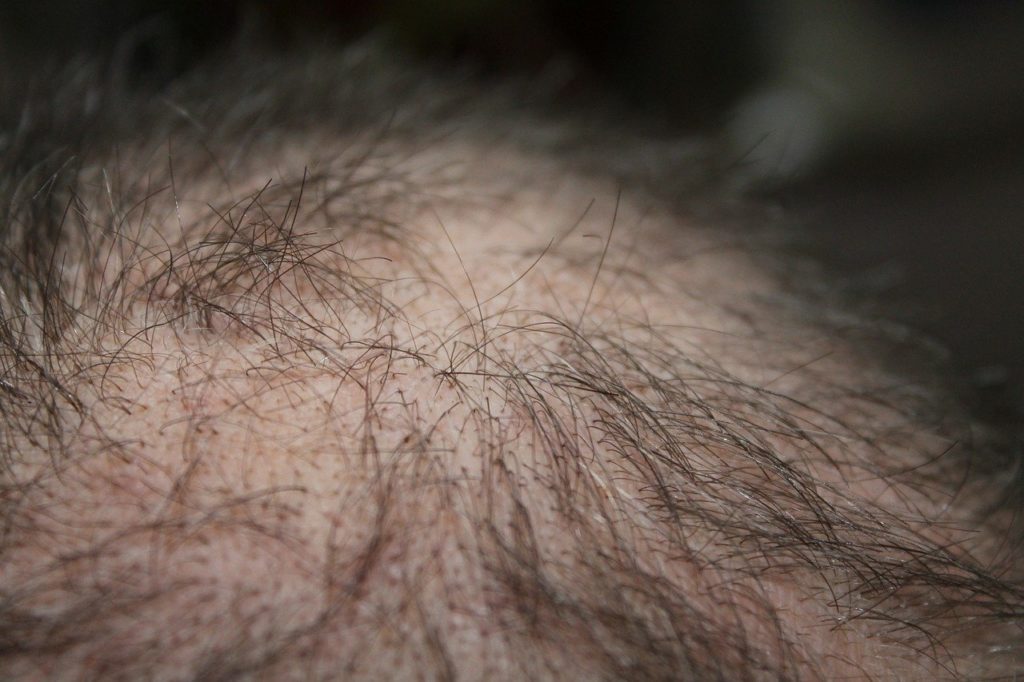 creatine-hair-loss