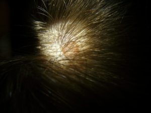 scalp folliculitis