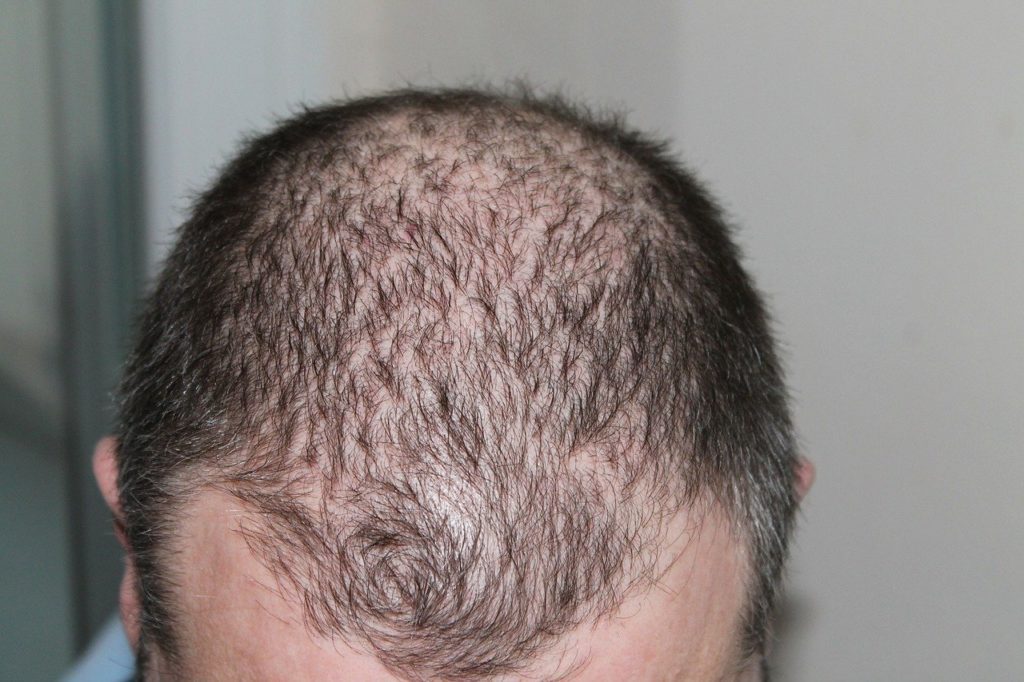 receding hairline